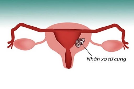 Cường estrogen – Yếu tố gây nhân xơ tử cung